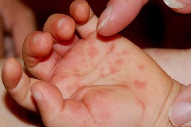 Giai đoạn khởi phát của bệnh tay chân miệng có biểu hiện gì?